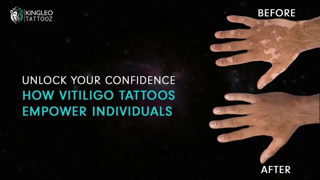 vitiligo-tattoos